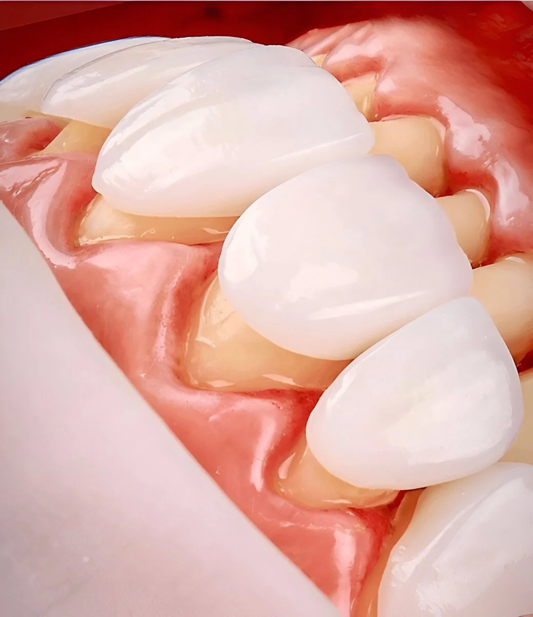 Dental veneers for crooked teeth