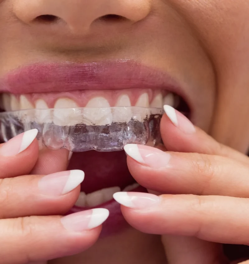 IslandSmiles - Custom MouthGuards