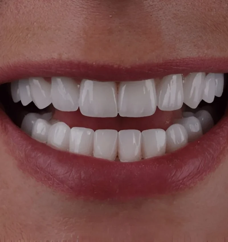 Best place to get veneers - IslandSmiles
